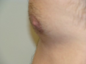 Nipple Reduction Before and After 10 | Grover Aesthetics