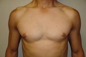 Nipple Reduction Before and After 10 | Sanjay Grover MD FACS