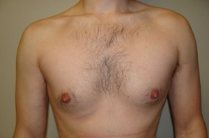 Nipple Reduction Before and After 13 | Sanjay Grover MD FACS