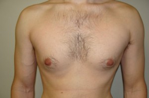 Nipple Reduction Before and After | Grover Aesthetics