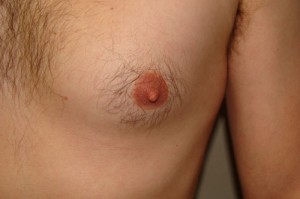 Nipple Reduction Before and After 11 | Grover Aesthetics