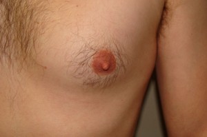 Nipple Reduction Before and After 11 | Sanjay Grover MD FACS