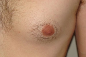 Nipple Reduction Before and After 11 | Grover Aesthetics