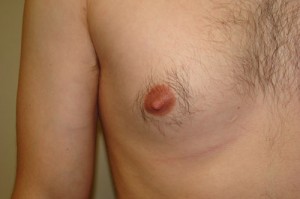 Nipple Reduction Before and After 11 | Grover Aesthetics