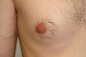 Nipple Reduction Before and After 11 | Grover Aesthetics