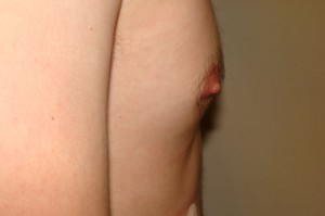 Nipple Reduction Before and After 11 | Grover Aesthetics