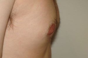 Nipple Reduction Before and After 11 | Grover Aesthetics