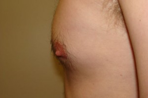 Nipple Reduction Before and After 11 | Grover Aesthetics