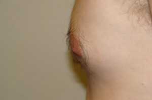 Nipple Reduction Before and After 11 | Grover Aesthetics