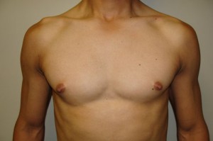 Nipple Reduction Before and After | Grover Aesthetics