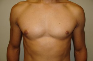 Nipple Reduction Before and After | Grover Aesthetics
