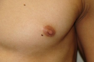 Nipple Reduction Before and After 12 | Grover Aesthetics