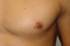 Nipple Reduction Before and After 12 | Grover Aesthetics