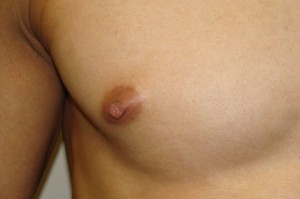 Nipple Reduction Before and After 12 | Grover Aesthetics