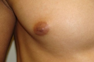 Nipple Reduction Before and After 12 | Grover Aesthetics