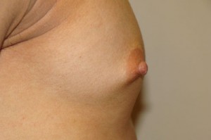 Nipple Reduction Before and After 12 | Grover Aesthetics