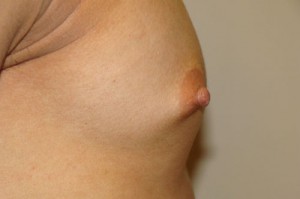 Nipple Reduction Before and After 12 | Sanjay Grover MD FACS