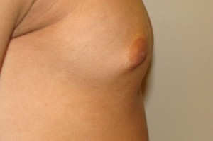 Nipple Reduction Before and After 12 | Grover Aesthetics