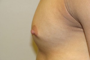 Nipple Reduction Before and After 12 | Grover Aesthetics