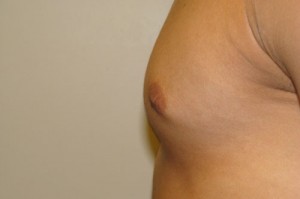 Nipple Reduction Before and After 12 | Grover Aesthetics