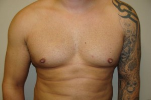Nipple Reduction Before and After 01 | Sanjay Grover MD FACS
