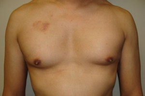 Nipple Reduction Before and After | Grover Aesthetics