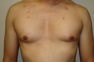 Nipple Reduction Before and After | Grover Aesthetics