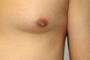 Nipple Reduction Before and After 13 | Grover Aesthetics