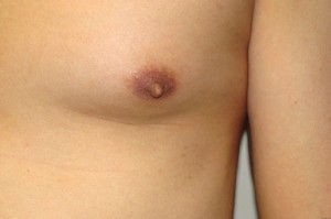 Nipple Reduction Before and After 13 | Sanjay Grover MD FACS