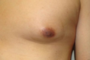 Nipple Reduction Before and After 13 | Grover Aesthetics