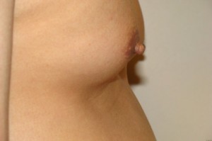 Nipple Reduction Before and After 13 | Grover Aesthetics