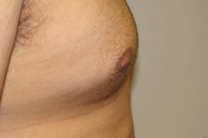Nipple Reduction Before and After 13 | Sanjay Grover MD FACS