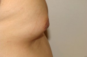 Nipple Reduction Before and After 13 | Grover Aesthetics