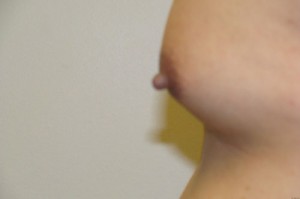 Nipple Reduction Before and After 13 | Grover Aesthetics