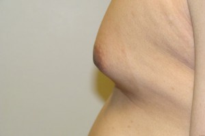 Nipple Reduction Before and After 13 | Grover Aesthetics