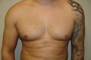 Nipple Reduction Before and After | Grover Aesthetics