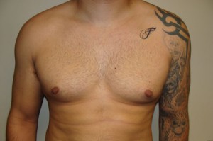 Nipple Reduction Before and After | Grover Aesthetics