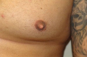 Nipple Reduction Before and After 14 | Grover Aesthetics