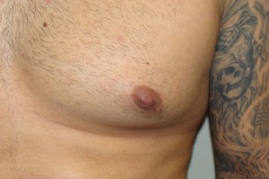 Nipple Reduction Before and After 14 | Grover Aesthetics