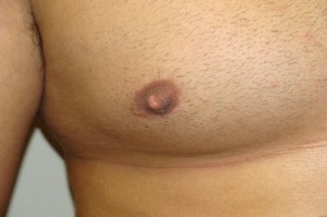 Nipple Reduction Before and After 14 | Grover Aesthetics
