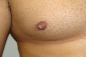 Nipple Reduction Before and After 14 | Sanjay Grover MD FACS