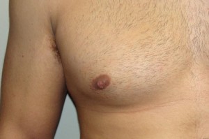 Nipple Reduction Before and After 14 | Grover Aesthetics