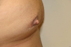 Nipple Reduction Before and After 14 | Grover Aesthetics