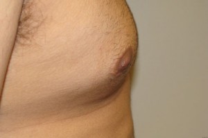 Nipple Reduction Before and After 14 | Grover Aesthetics