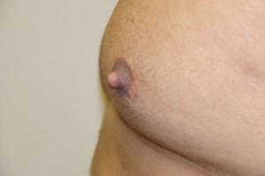 Nipple Reduction Before and After 14 | Grover Aesthetics
