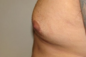Nipple Reduction Before and After 14 | Grover Aesthetics