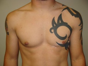 Nipple Reduction Before and After | Grover Aesthetics