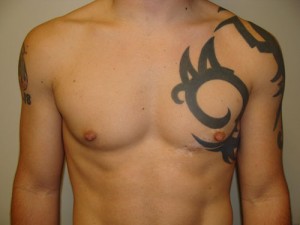 Nipple Reduction Before and After | Grover Aesthetics
