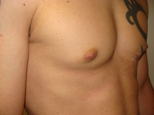 Nipple Reduction Before and After 15 | Grover Aesthetics