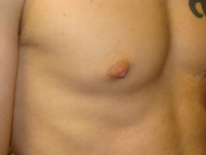 Nipple Reduction Before and After 15 | Grover Aesthetics